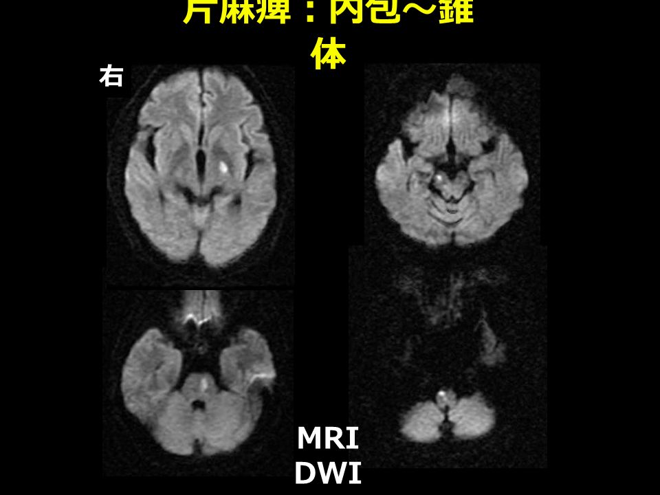 片麻痺：内包～錐 体 MRI DWI 右
