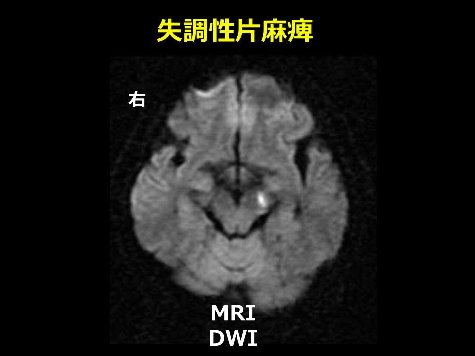 失調性片麻痺 右 MRI DWI