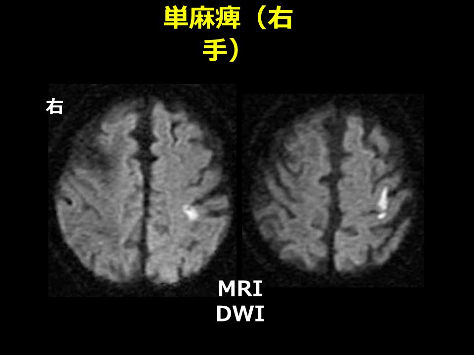 単麻痺（右 手） 右 MRI DWI