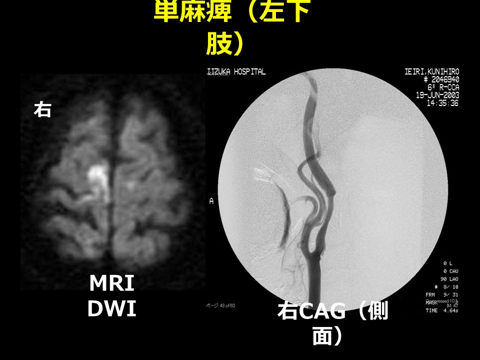 単麻痺（左下 肢） 右 MRI DWI 右 CAG （側 面）
