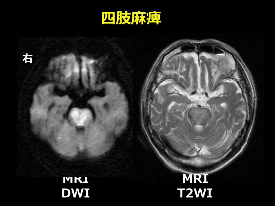 四肢麻痺 MRI DWI 右 MRI T2WI