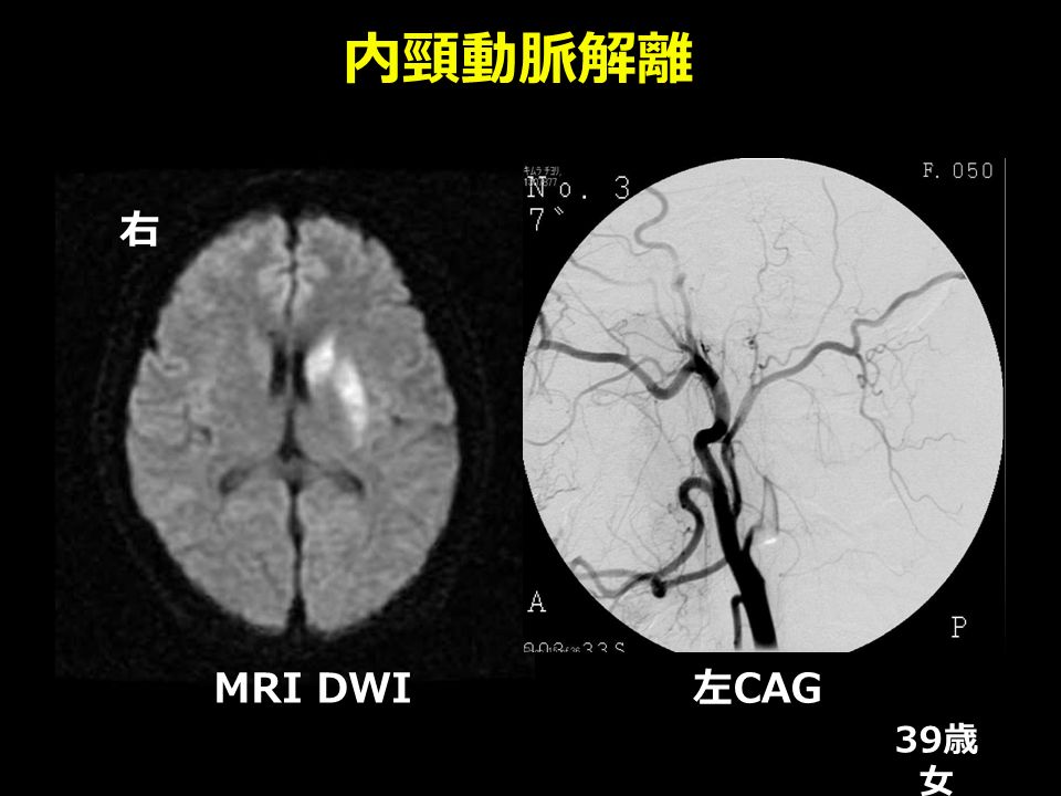 内頸動脈解離 右 MRI DWI 39 歳 女 左 CAG