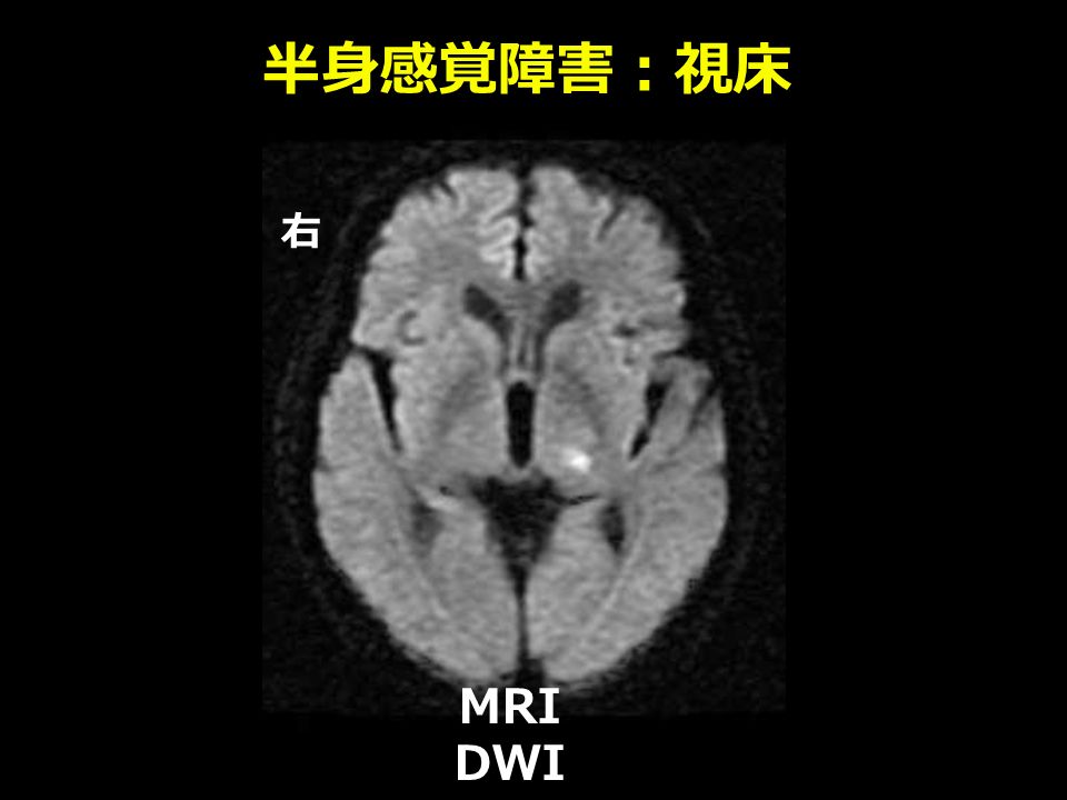 半身感覚障害：視床 MRI DWI 右
