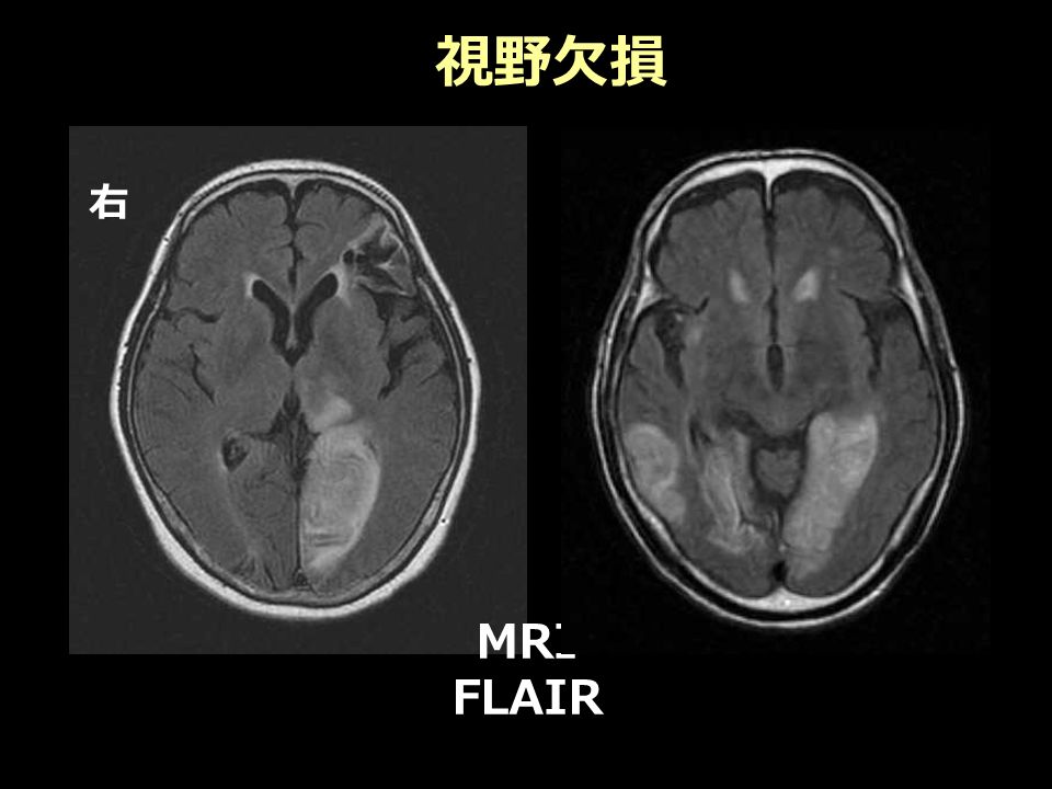 視野欠損 右 MRI FLAIR