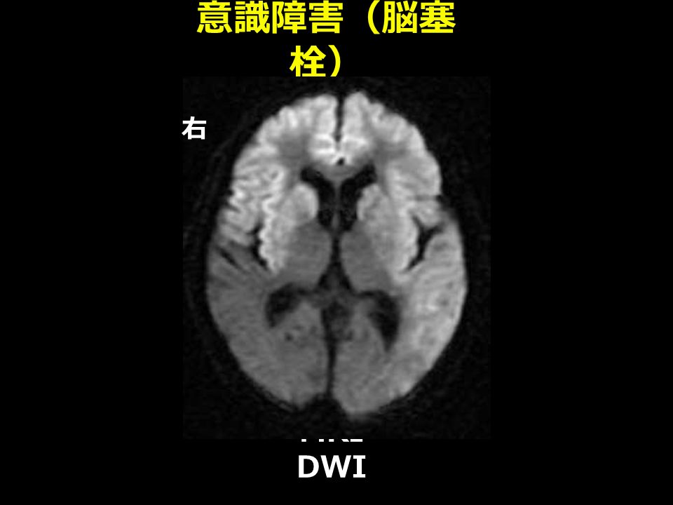 意識障害（脳塞 栓） MRI DWI 右