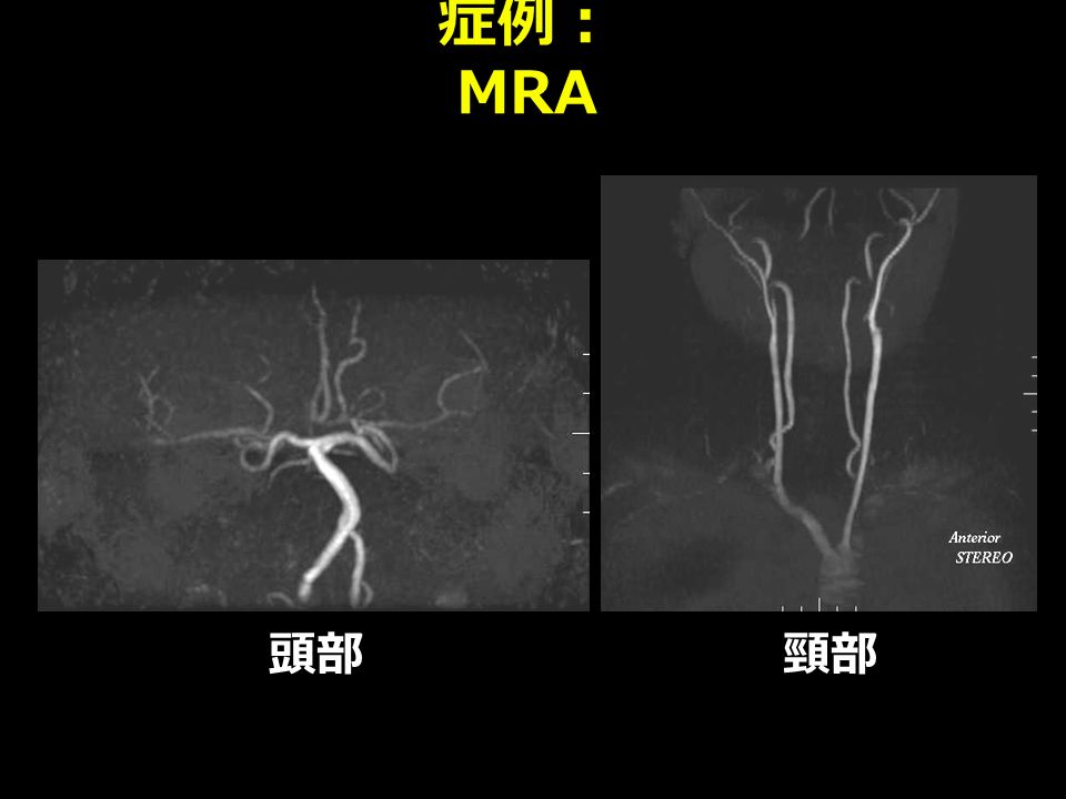 症例： MRA 頭部頸部