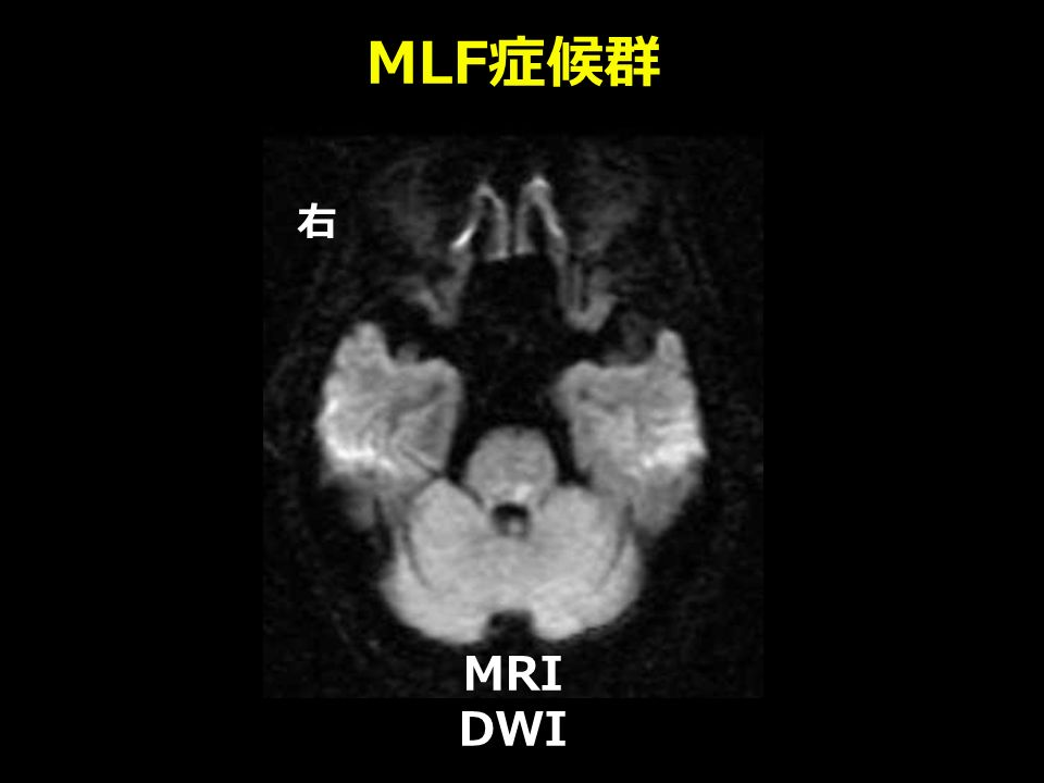 MLF 症候群 MRI DWI 右