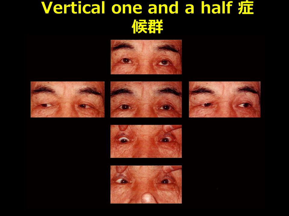 Vertical one and a half 症 候群