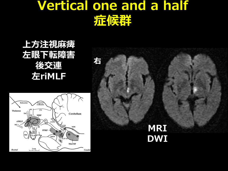 MRI DWI 右 上方注視麻痺 左眼下転障害 後交連 左 riMLF