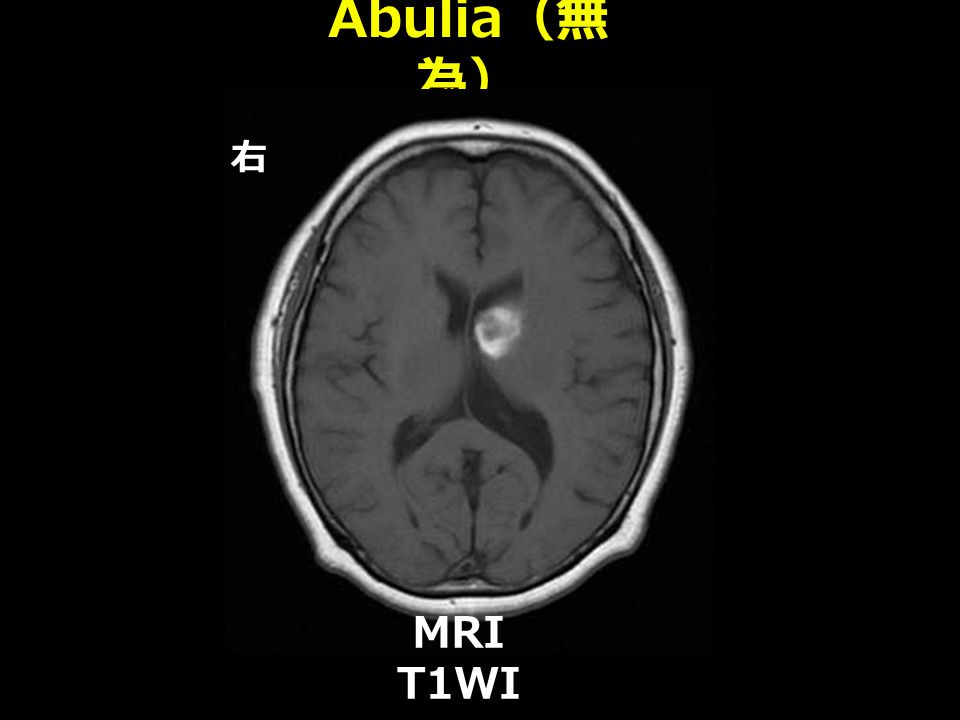 Abulia （無 為） 右 MRI T1WI