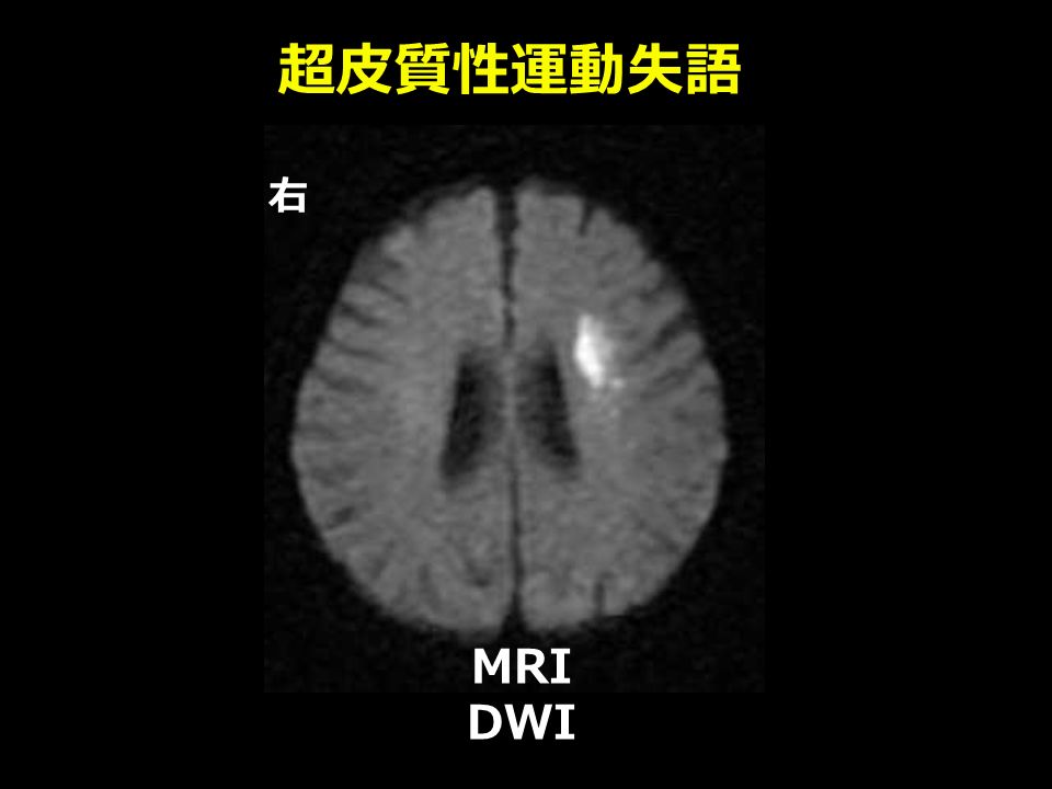 超皮質性運動失語 右 MRI DWI