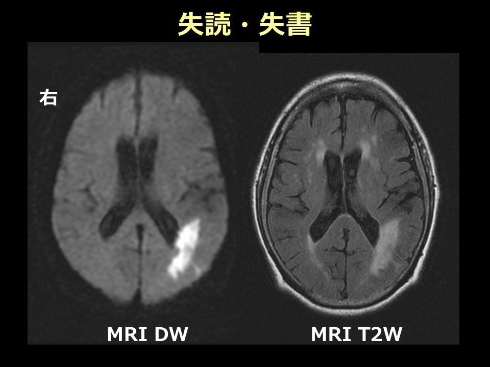 失読・失書 右 MRI DWMRI T2W