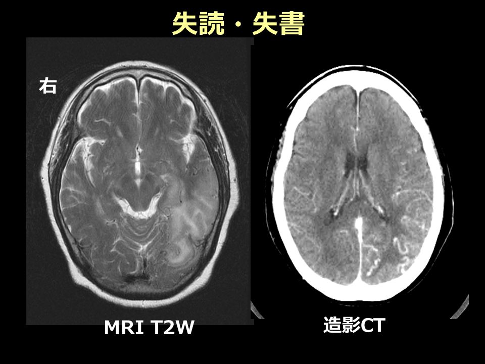 右 造影 CT MRI T2W 失読・失書
