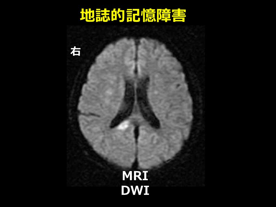 MRI DWI 地誌的記憶障害 右