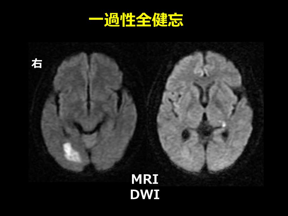 一過性全健忘 右 MRI DWI
