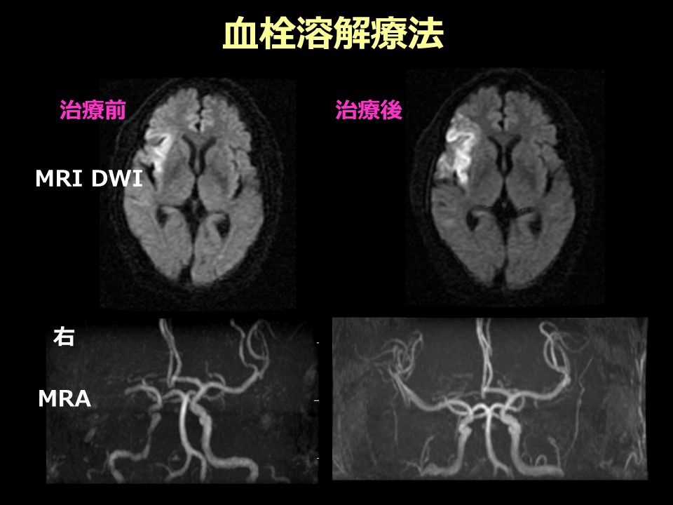 血栓溶解療法 右 治療前治療後 MRI DWI MRA