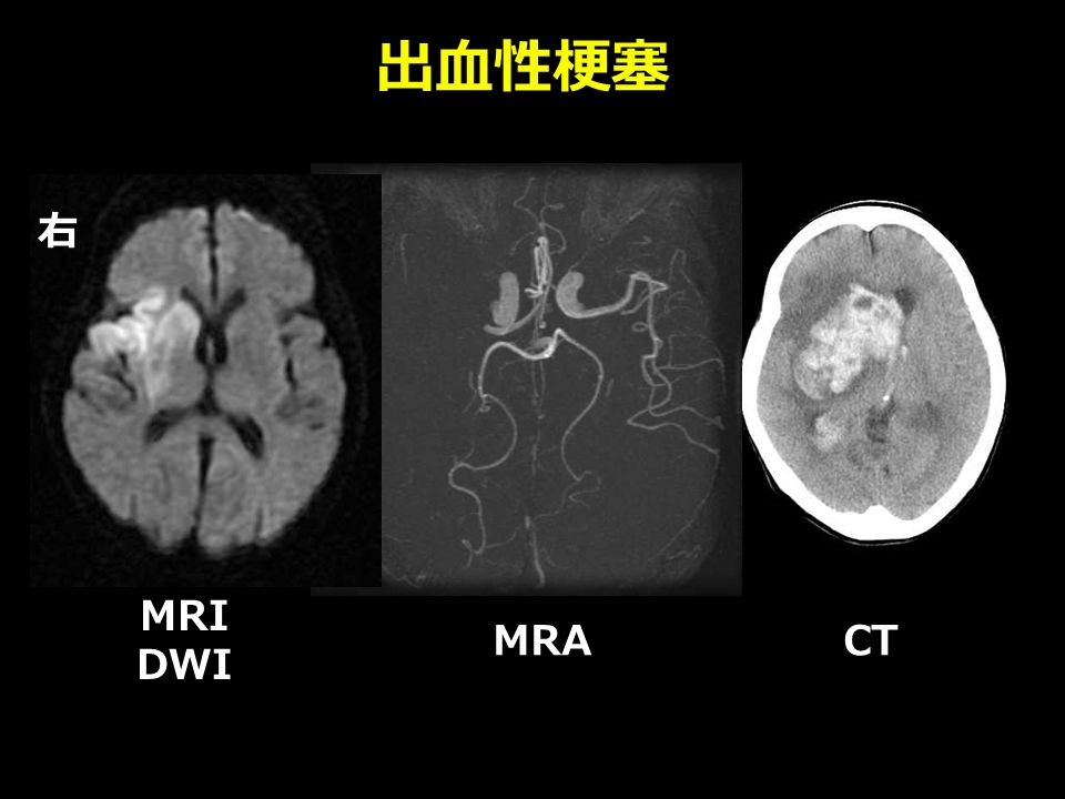出血性梗塞 MRI DWI 右 MRACT