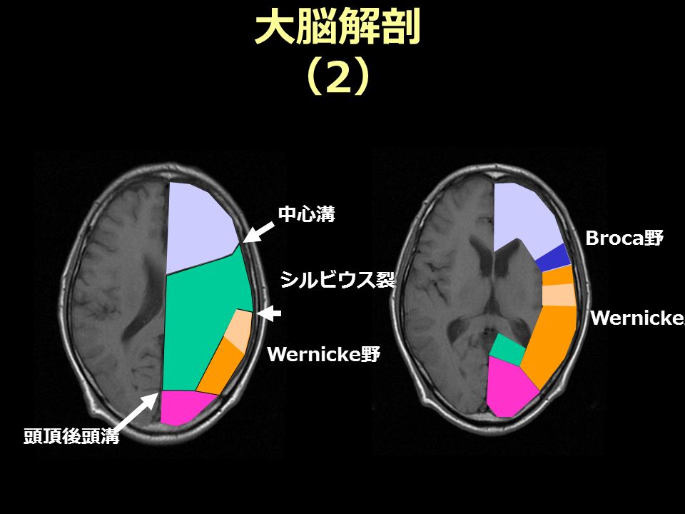 大脳解剖 （ 2 ） 頭頂後頭溝 中心溝 Wernicke 野 Broca 野 Wernicke 野 シルビウス裂