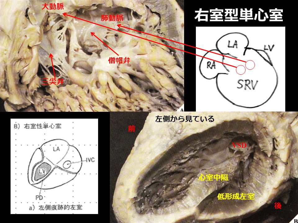 低形成左室 三尖弁 肺動脈 大動脈 心室中隔 右室型単心室 僧帽弁 前 後 VSD 左側から見ている