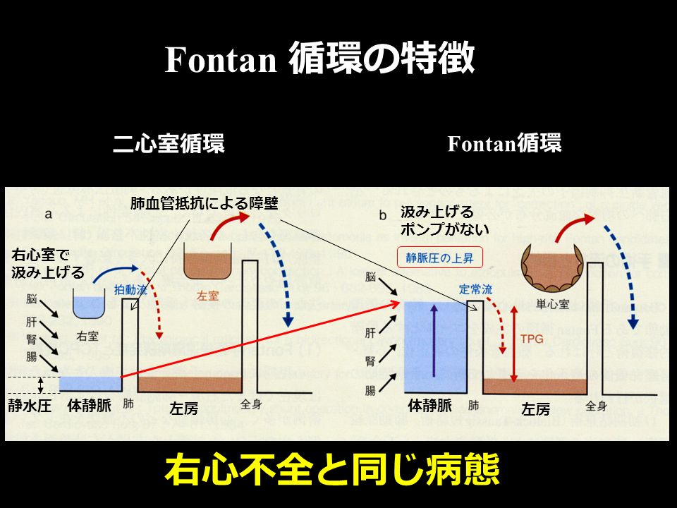 Fontan 循環の特徴 二心室循環 Fontan 循環 左房 右心室で 汲み上げる 肺血管抵抗による障壁 汲み上げる ポンプがない 体静脈 静水圧 右心不全と同じ病態