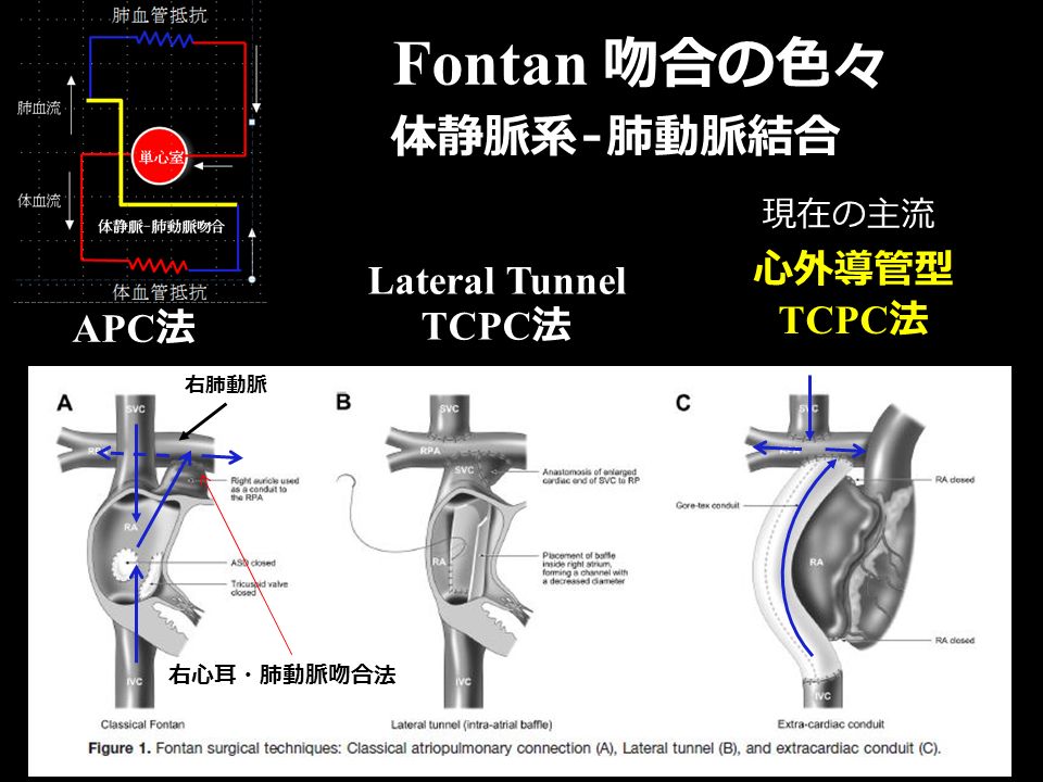 APC 法 Lateral Tunnel TCPC 法 心外導管型 TCPC 法 Fontan 吻合の色々 右心耳・肺動脈吻合法 現在の主流 体静脈系 - 肺動脈結合 右肺動脈