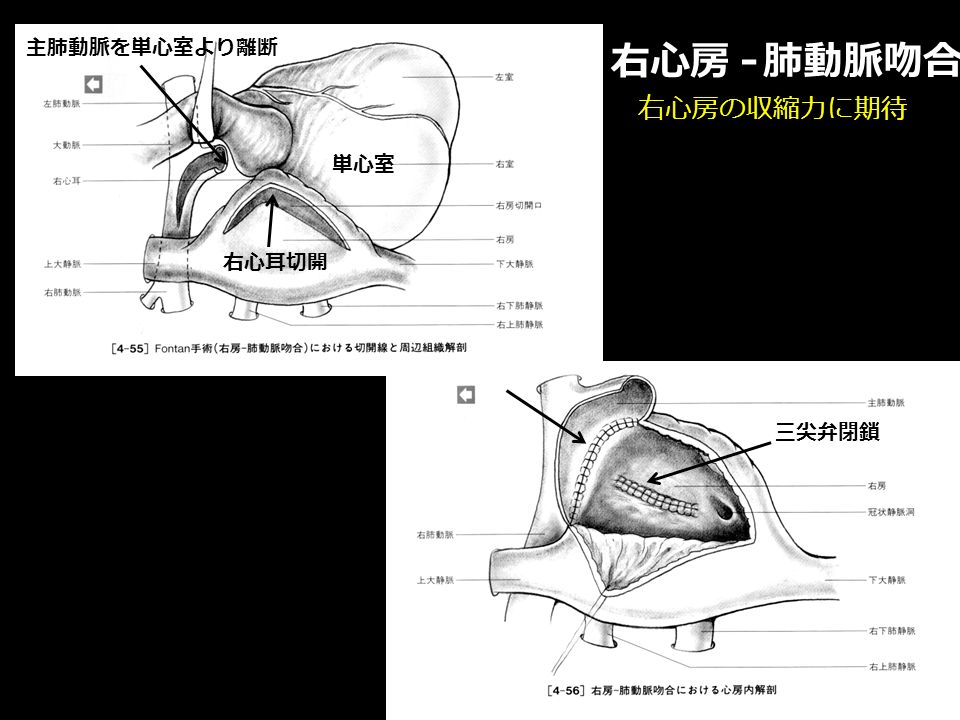 右心房 - 肺動脈吻合 右心房の収縮力に期待 三尖弁閉鎖 主肺動脈を単心室より離断 右心耳切開 単心室