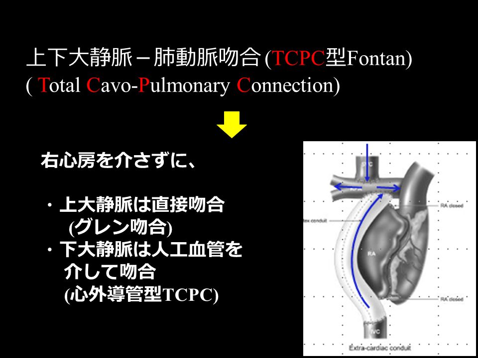 上下大静脈－肺動脈吻合 (TCPC 型 Fontan) ( Total Cavo-Pulmonary Connection) 右心房を介さずに、 ・上大静脈は直接吻合 ( グレン吻合 ) ・下大静脈は人工血管を 介して吻合 ( 心外導管型 TCPC)