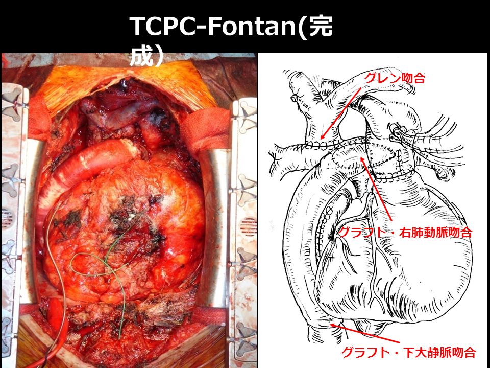 TCPC-Fontan( 完 成） グラフト・右肺動脈吻合 グラフト・下大静脈吻合 グレン吻合