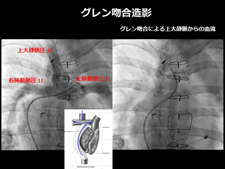 グレン吻合造影 右肺動脈圧 11 左肺動脈圧 11 上大静脈圧 11 グレン吻合による上大静脈からの血流