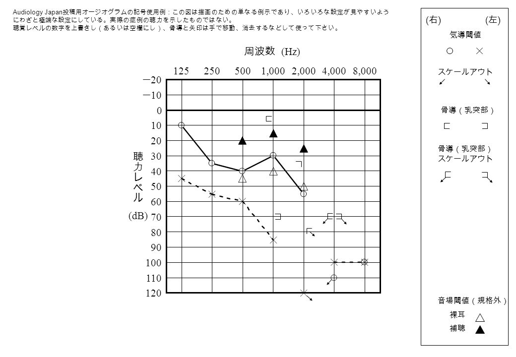 このオージオグラム描画ソフト テンプレート の使い方 １ このテンプレートでは 閾値ないしスケールアウトの記号を次のようにして描きます 気導聴力レベルと音場閾値は Powerpoint の Graph 機能を用いて表に数値を入力 自動配置 骨導聴力レベル 乳突部 前額部