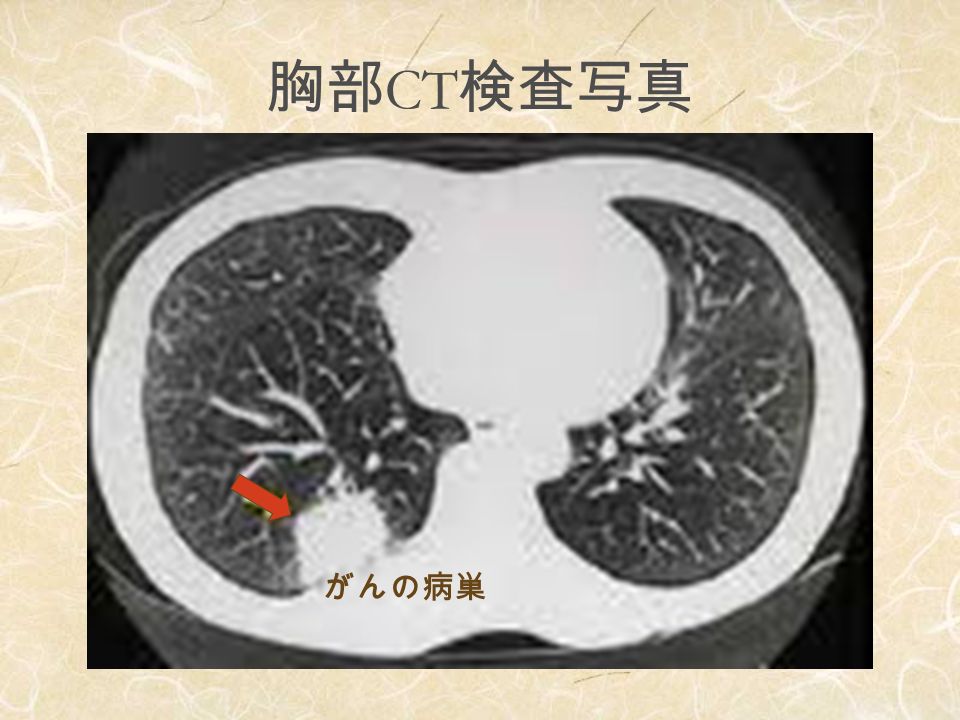 胸部 CT 検査写真 がんの病巣